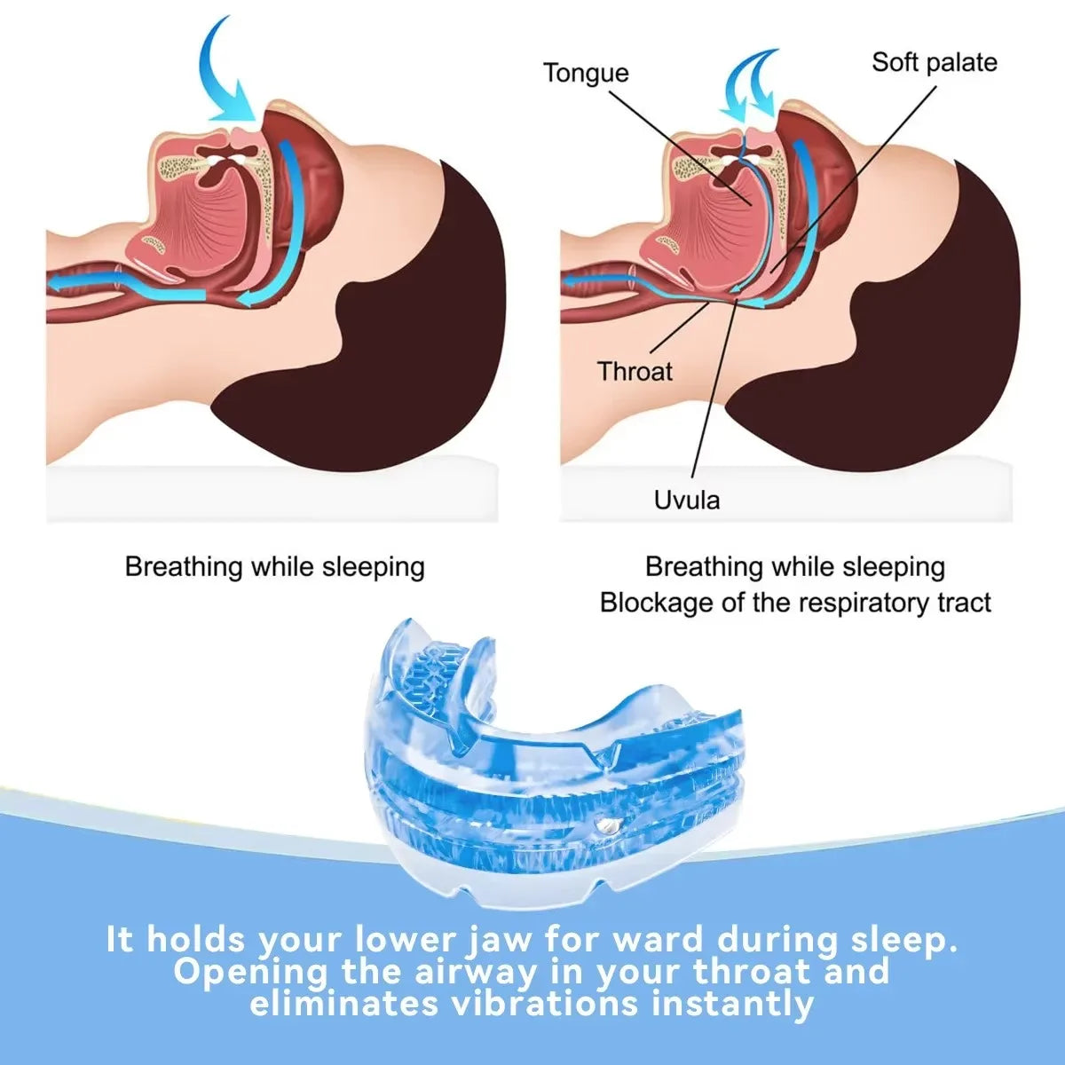 Advanced mandibular orthosis with precise adjustment and soft comfort